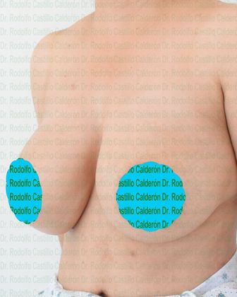 Before Breast Reduction